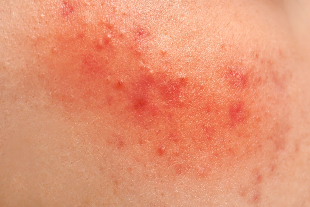 Dermatitis asociada a incontinencia - TENA
